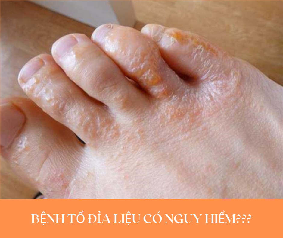 TỔ ĐỈA LIỆU CÓ NGUY HIỂM